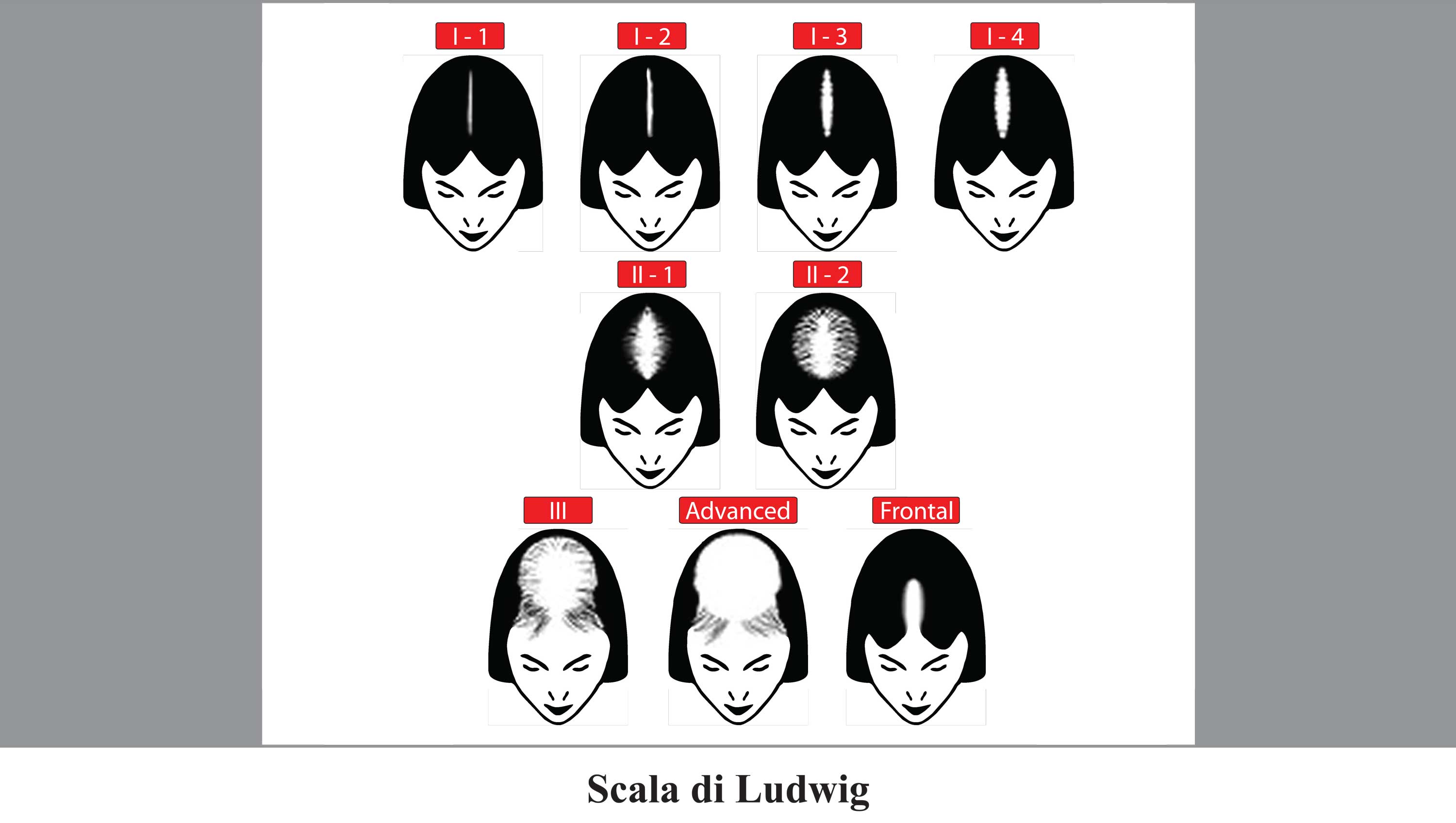 Calvizie femminile: alopecia androgenetica o telogen effluvio