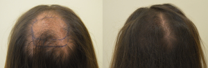 Restauro di crescita di capelli dopo un alopetion