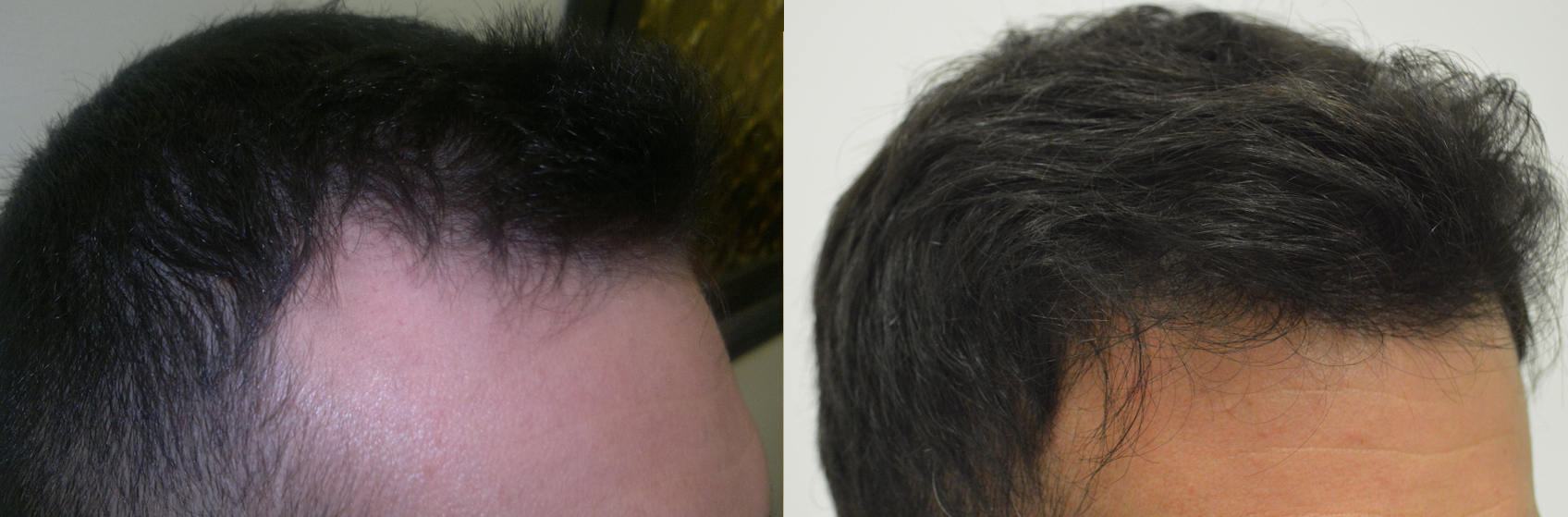 Punte secche di capelli di una maschera da olio di ricino