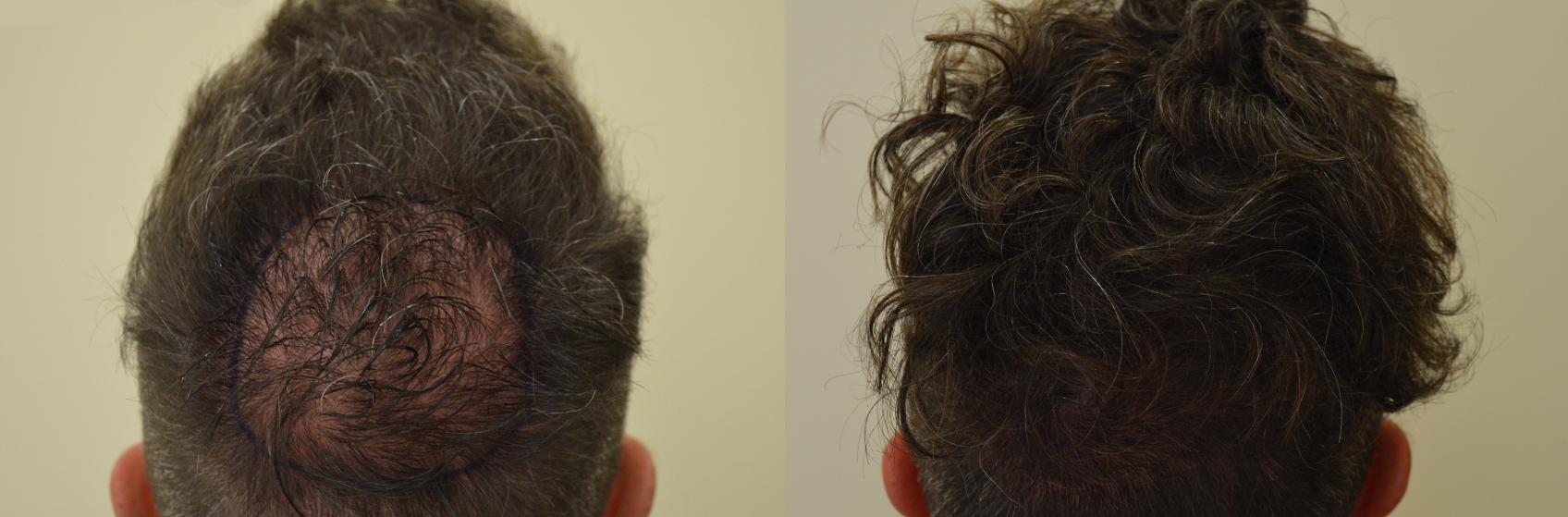 Il rimedio di gente che rallenta la crescita di capelli