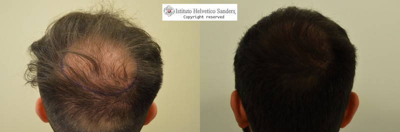 Da una perdita di capelli per capelli unti