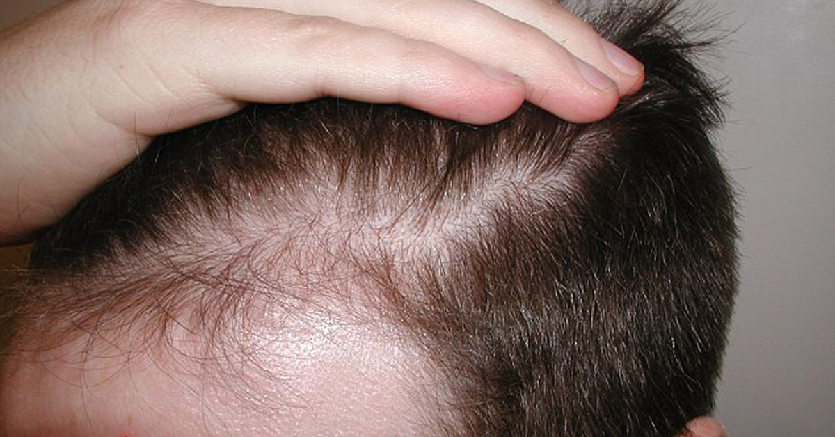 caduta capelli donna rimedi