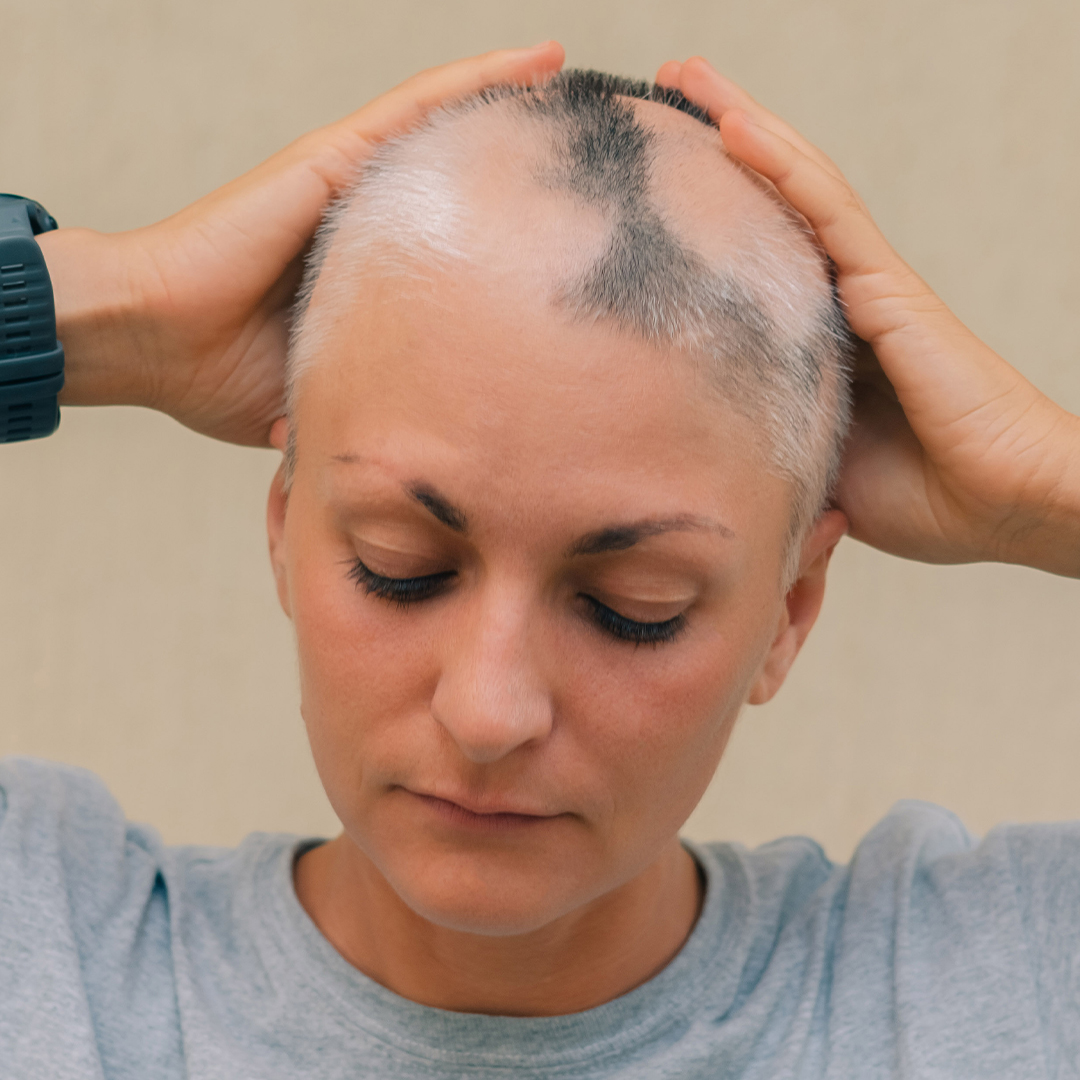 Altre tipologie di alopecia areata