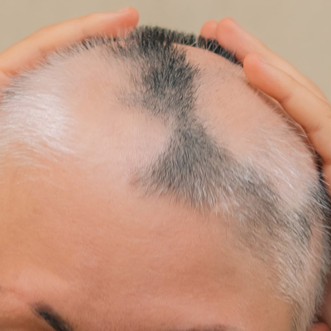 Alopecia areata altre tipologie di alopecia