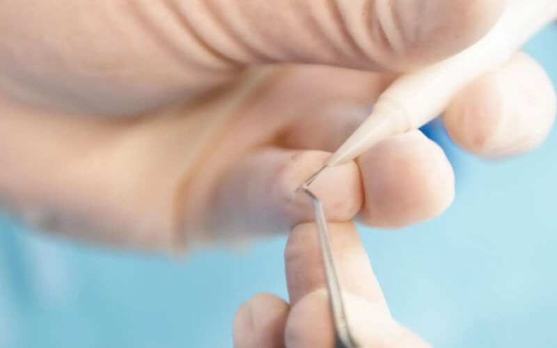 Preparazione del cuoio capelluto