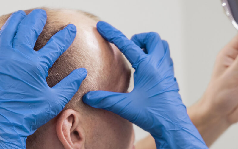 Tecniche chirurgiche avanzate FUE e DHI