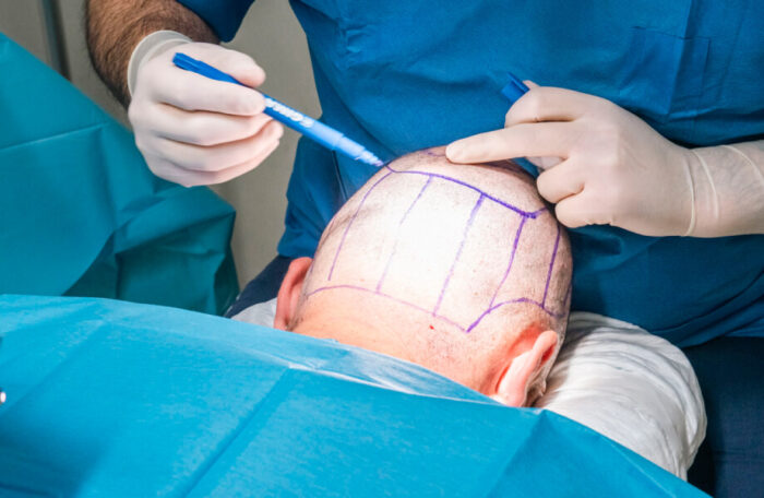 Trapianti di Capelli Eseguiti in Italia