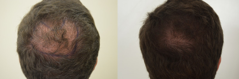 stress e perdita di capelli stress e perdita di capelli