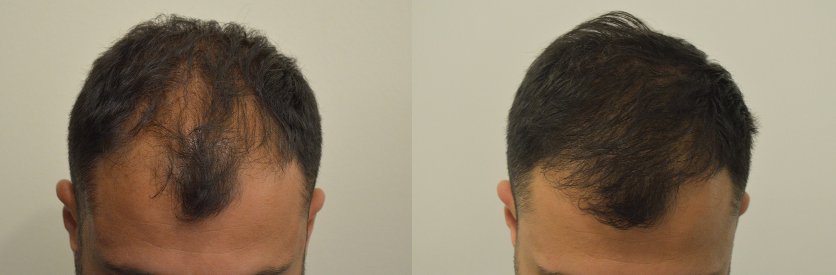 caduta capelli androgenetica rimedi caduta capelli androgenetica rimedi