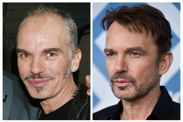 Trapianto capelli in turchia trapianto capelli: Thornton ha risolto i suoi problemi di calvizie