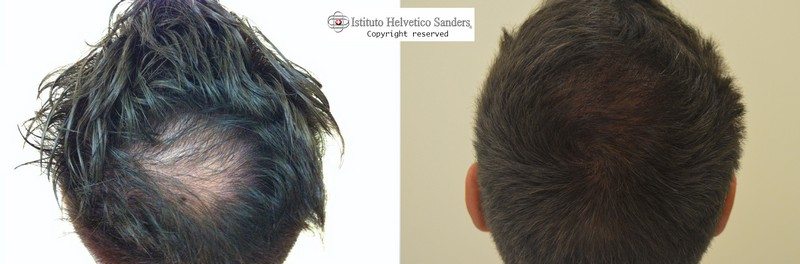 trapianto capelli zona vertice