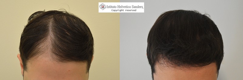 trapianto capelli prima dopo