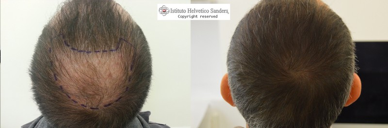 infoltimento vertice con autotrapianto di capelli