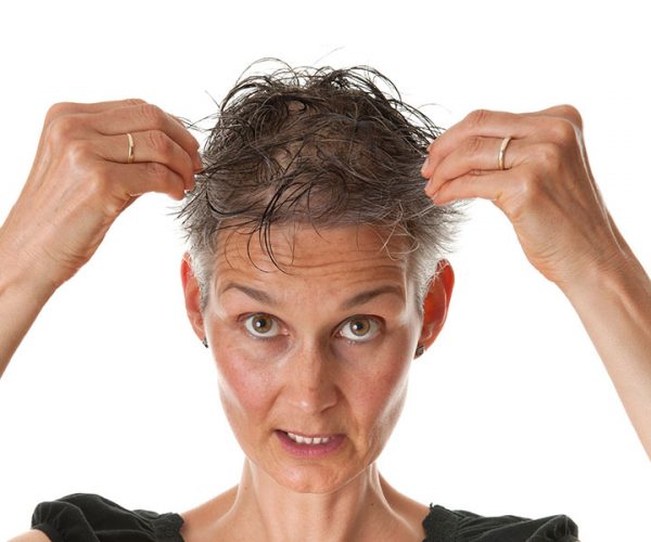 DHT e capelli, il ruolo del diidrotestosterone nella calvizie maschile