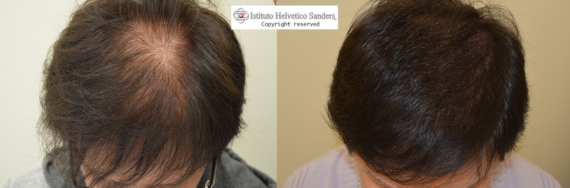Alopecia androgenetica femminile