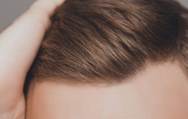 Attaccatura capelli