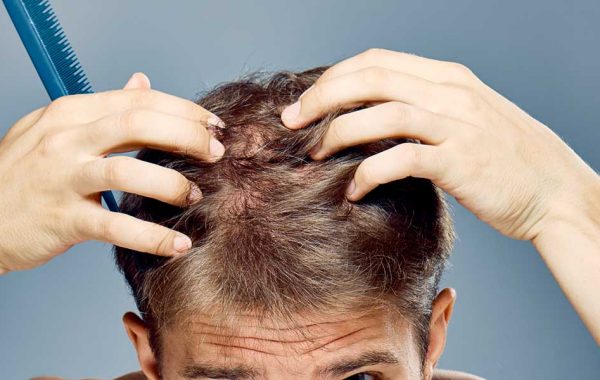 Tentativi Per Nascondere la Calvizie
