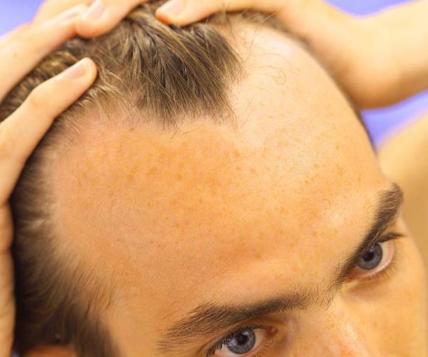 Omkostningsprocent ligegyldighed Fyrretræ Minoxidil: effetti collaterali e controindicazioni per la caduta dei capelli