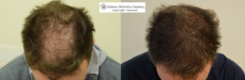 infoltimento capelli
