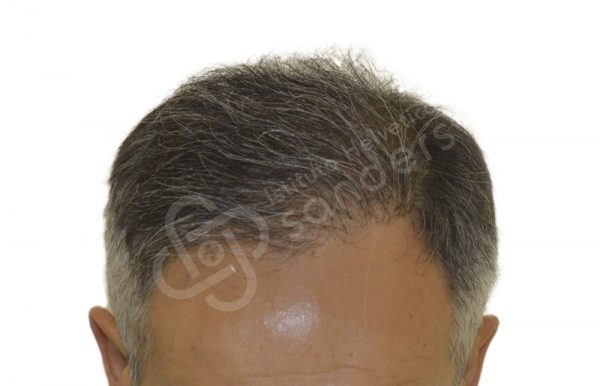 00