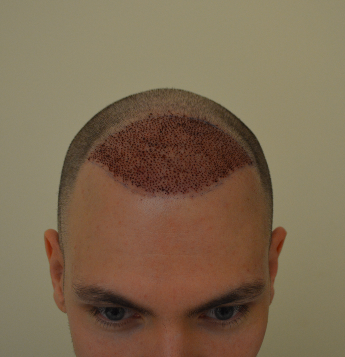 Autotrapianto capelli: l'esperienza di filippo Autotrapianto capelli: l'esperienza di Filippo - Sanders