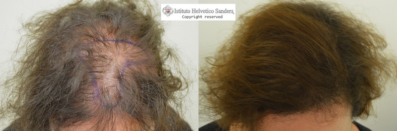trapianto capelli donna