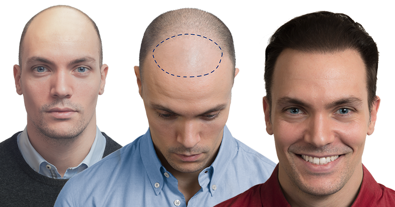 autotrapianto capelli esperienza di Filippo