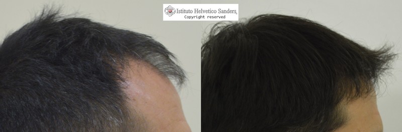 trapianto capelli laterale