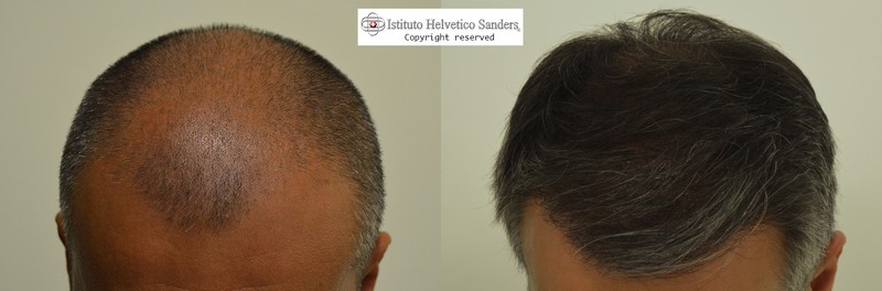 trapianto capelli prima e dopo