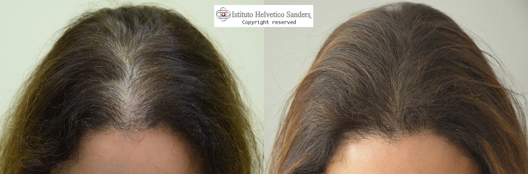 diradamento capelli frontale donne diradamento capelli frontale donne