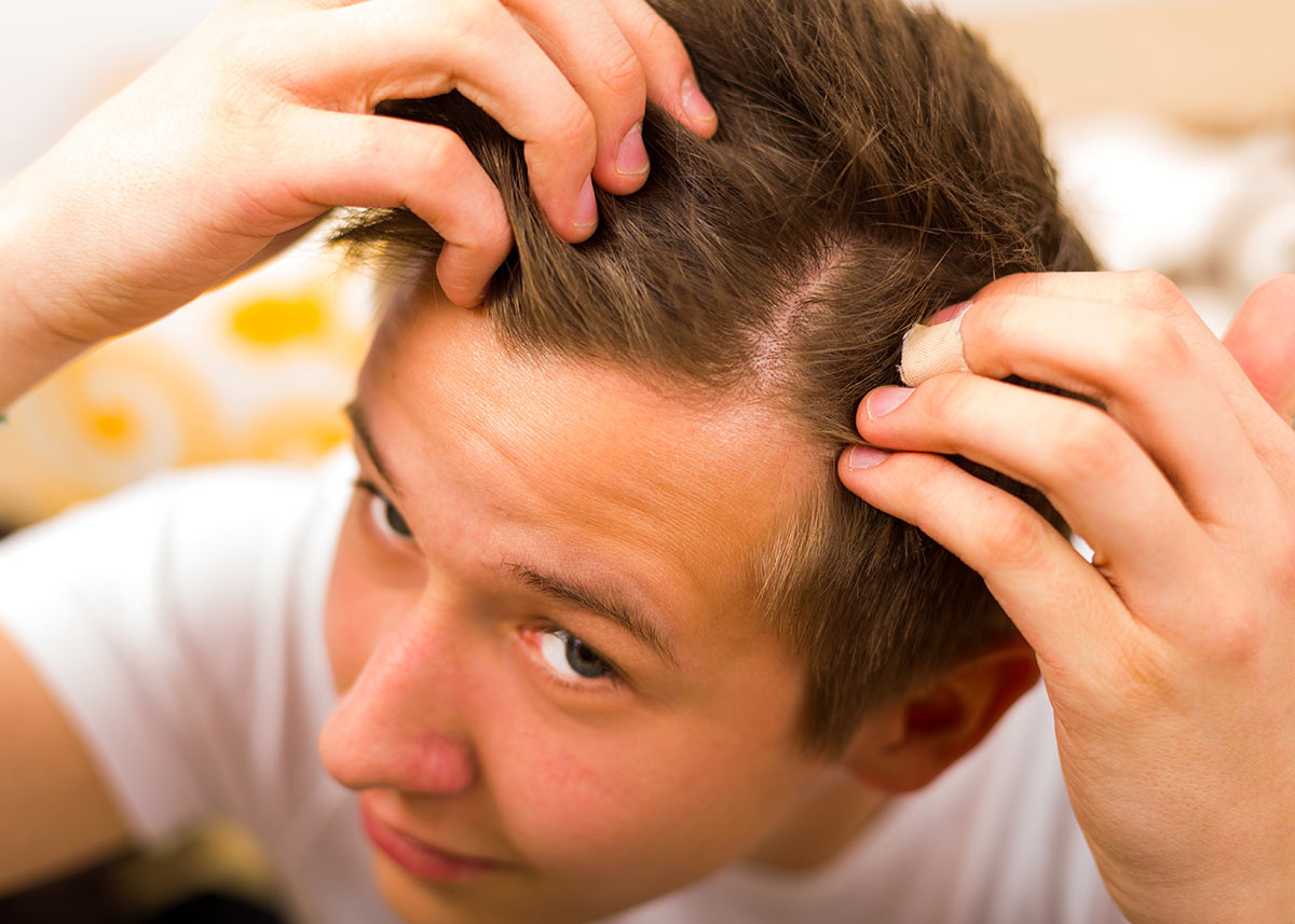 caduta capelli stress