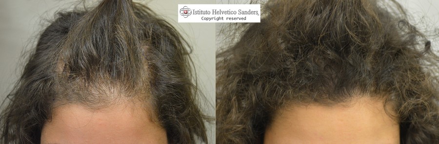 Il trapianto capelli nella donna: i vantaggi - Sanders