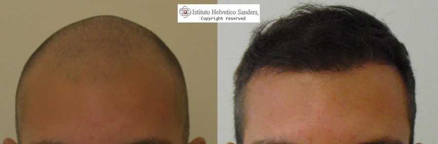 risultato trapianto capelli istituto helvetico sanders