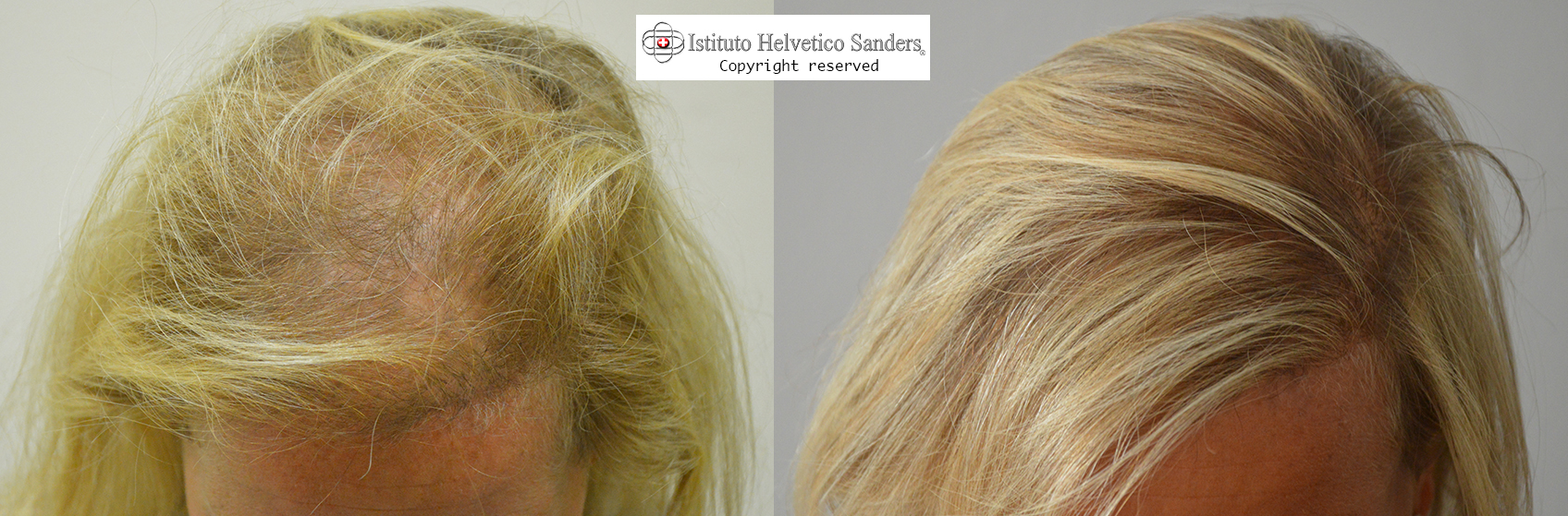 trapianto capelli nella donna