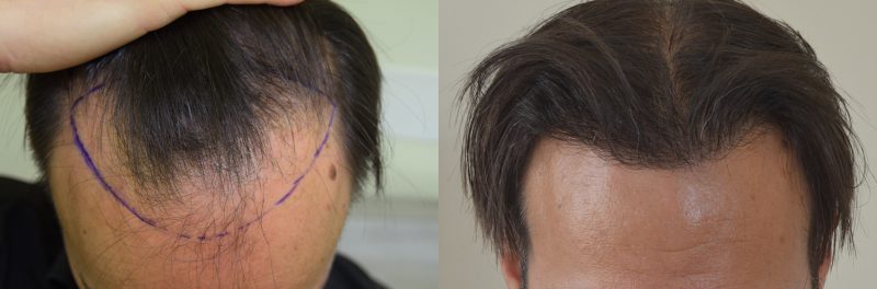 La Partita Di Nadal Contro La Calvizie I Risultati Del Trapianto