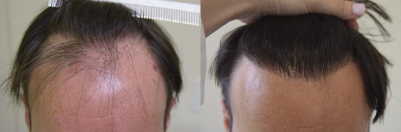 La Partita Di Nadal Contro La Calvizie I Risultati Del Trapianto