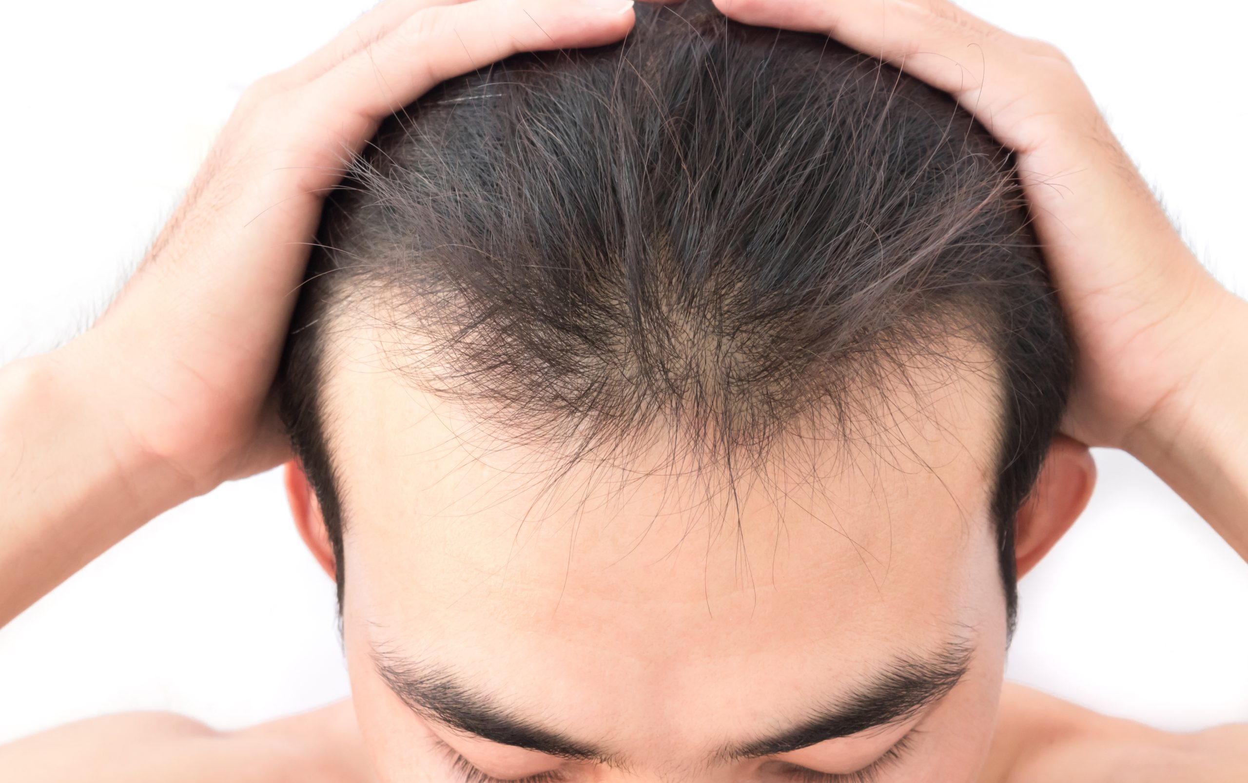 Как остановить выпадение волос в домашних. Выпадение волос у мужчин. Поредение волос у мужчин. Редеющие волосы у мужчин.
