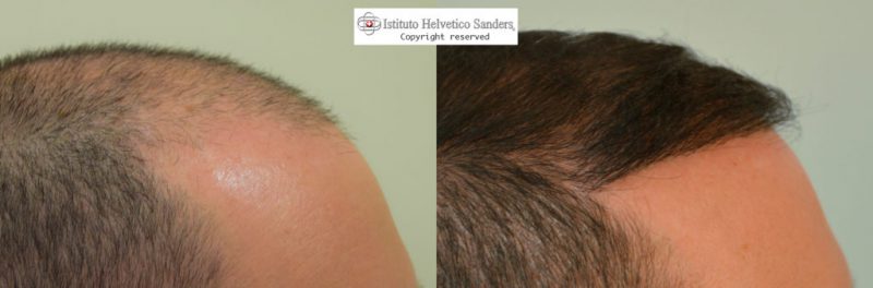 Risultati trapianto capelli zona laterale Risultati Trapianto capelli zona laterale - Istituto Helvetico Sanders