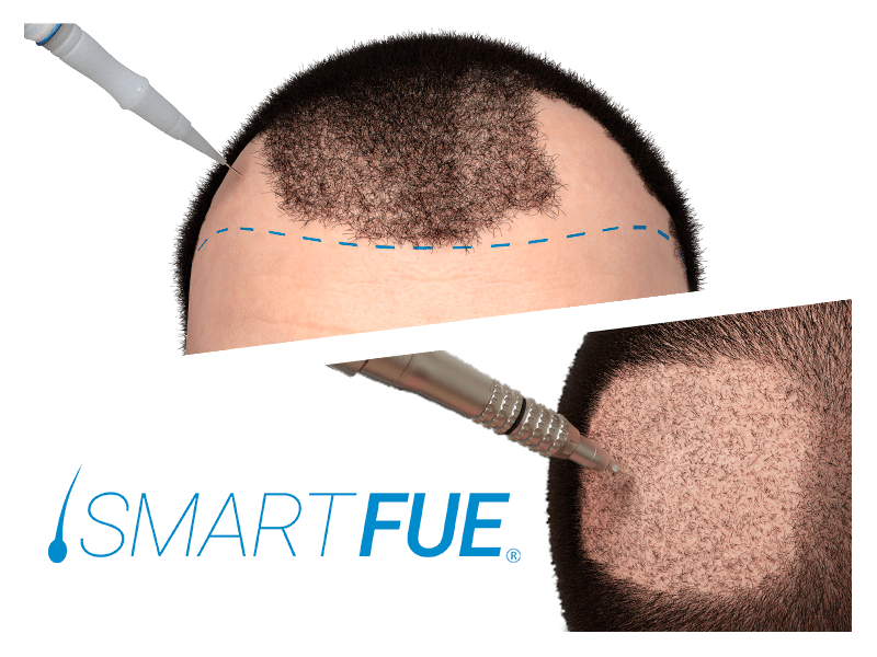 Rimedi Contro La Calvizie Maschile Soluzioni Caduta Capelli Uomo