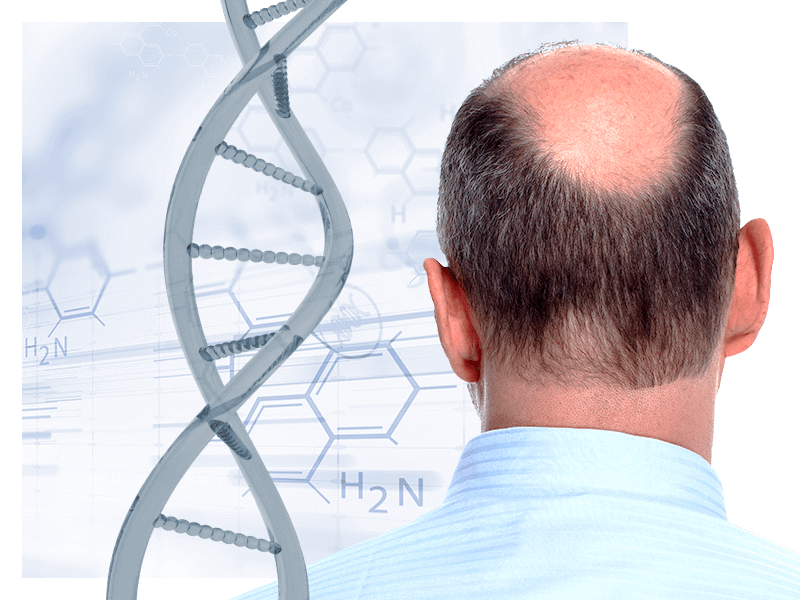 test-dna-hair-genetic-rischio-sviluppo-calvizie