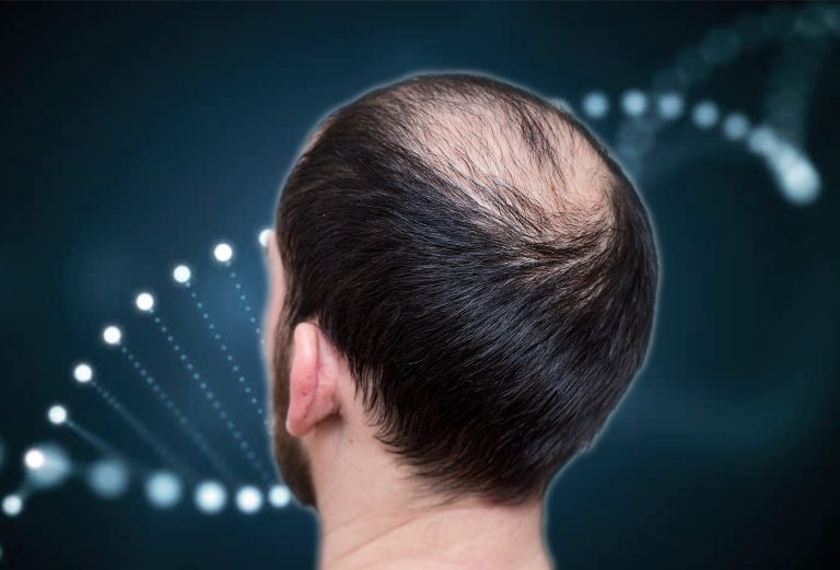 Autotrapianto capelli vertice: tecniche e risultati ottenibili