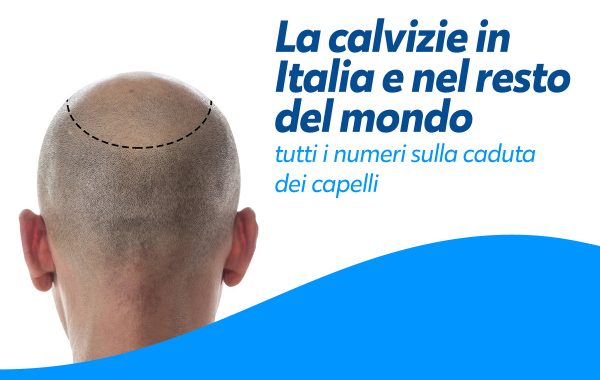 Calvizie e Trapianti: dati statistici e cause principali della caduta dei capelli