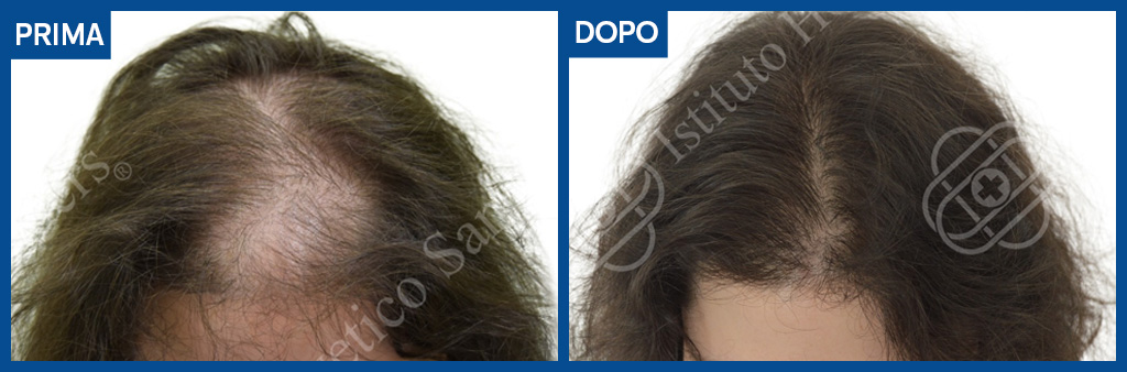 prima e dopo trapianto capelli donna