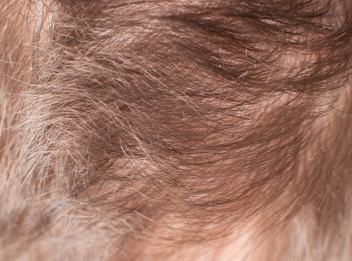 malassezia furfur