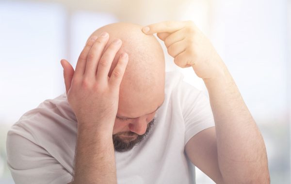 Cos'è l'alopecia universale e quali sono le cause