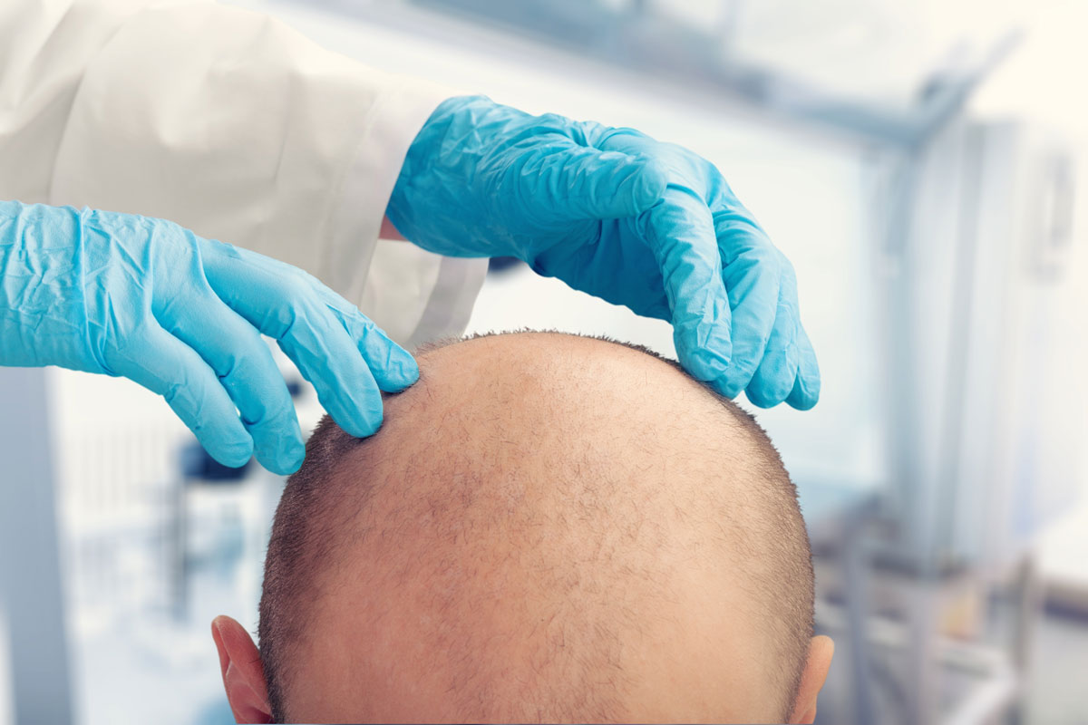 alopecia universale cause