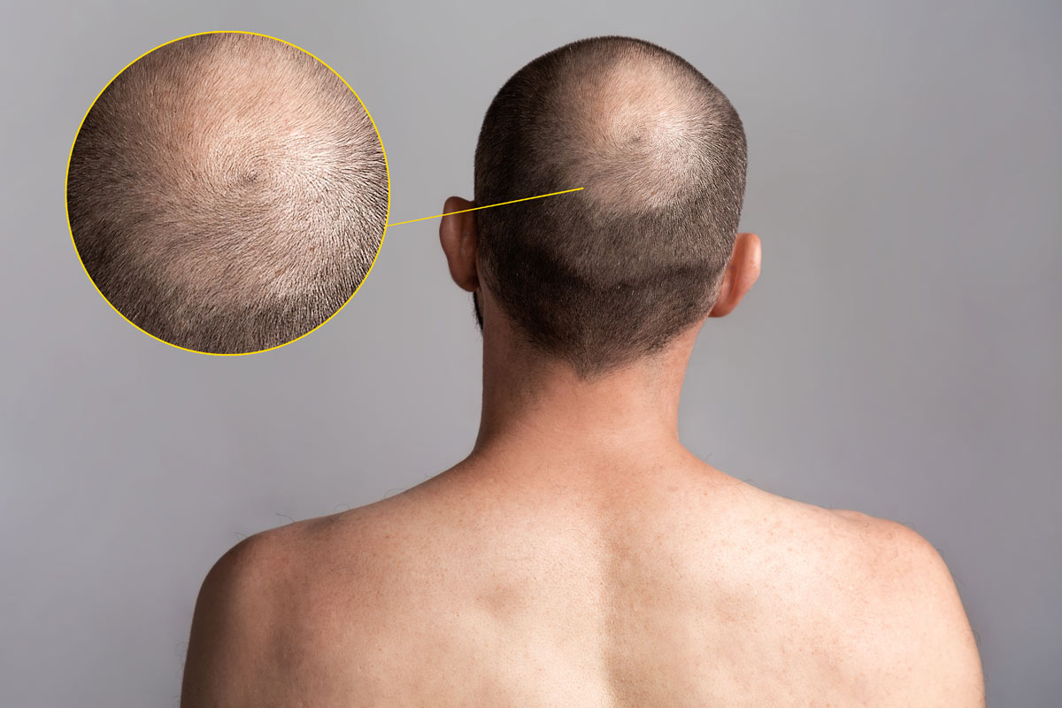 sintomi alopecia androgenetica
