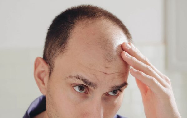 Come riconoscere l'alopecia androgenetica?