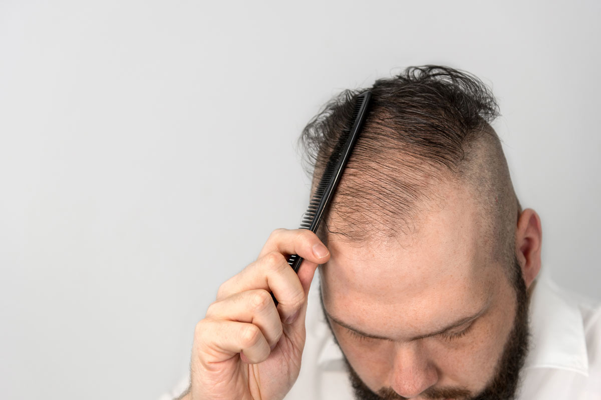 Quando può svilupparsi l'alopecia