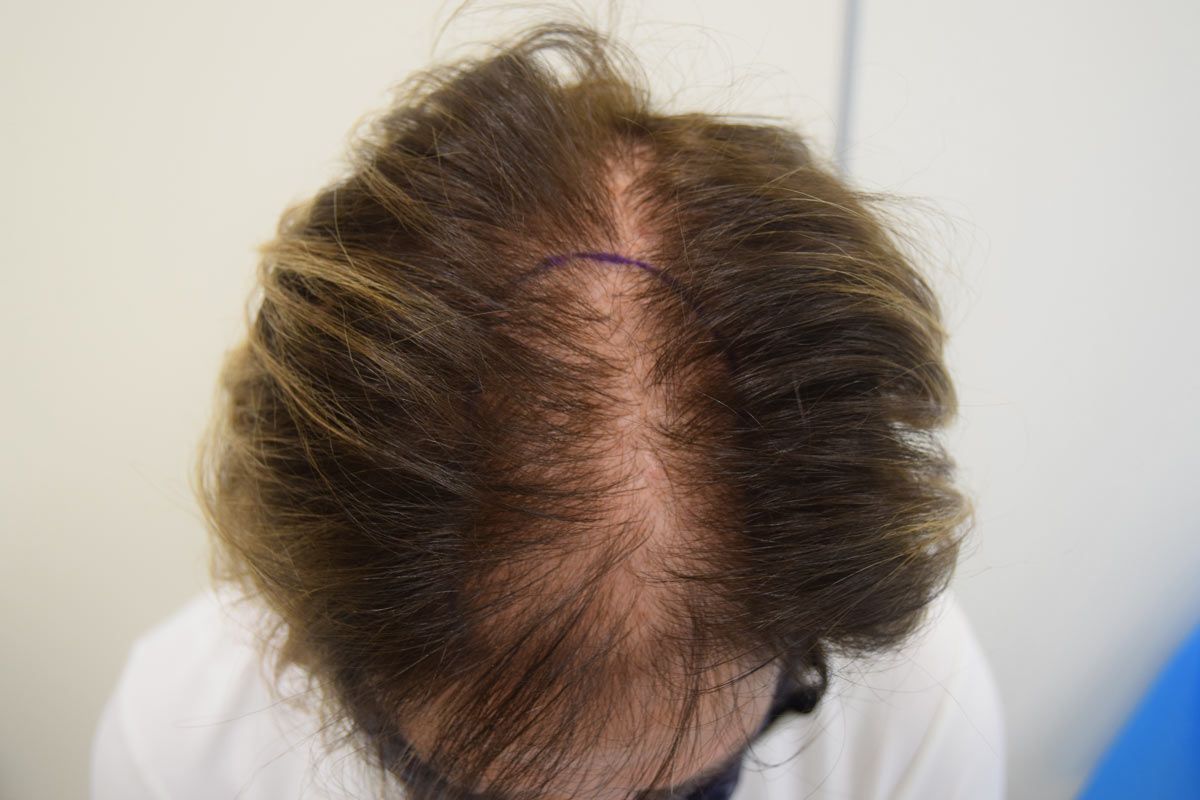 Alopecia femminile come curarla